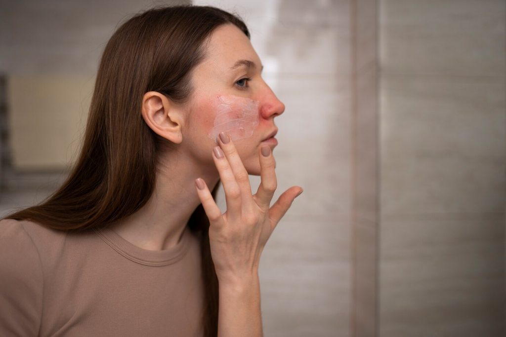 Crafting Effective Acne Treatment Products for Private Label
