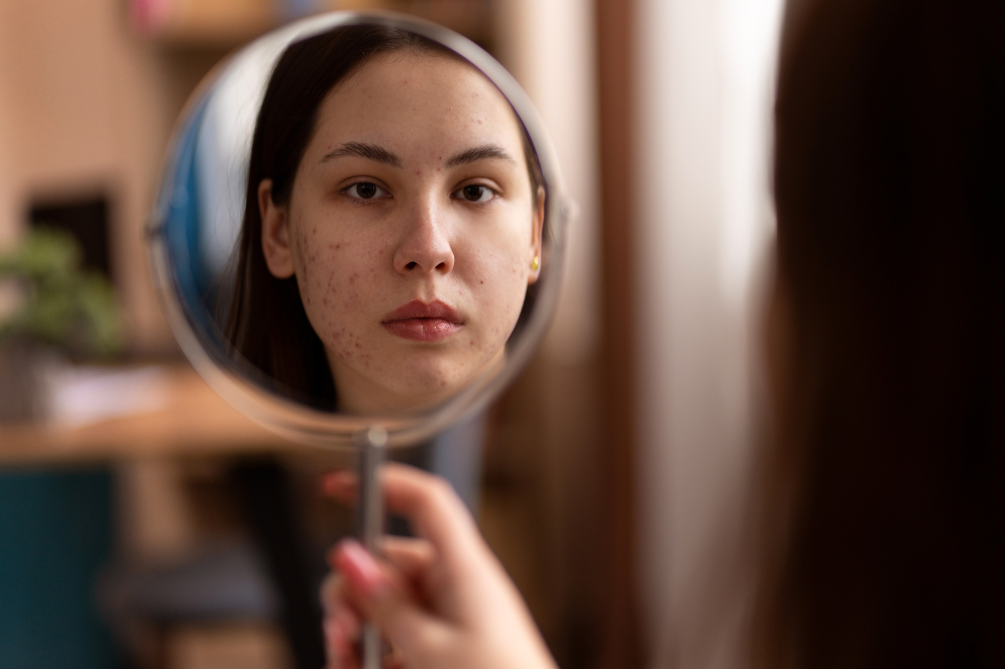 Top 8 Anti Acne Market Trends in 2025