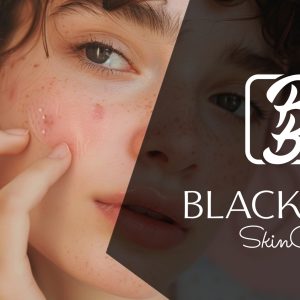 Acne Patch